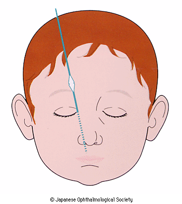 鼻涙管開放術（ブジー）のイメージ